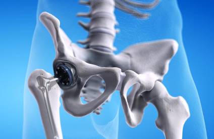 Hip Replacement Surgery Cost in Anna Nagar