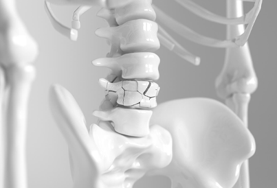 Spine Fracture surgery in Chennai